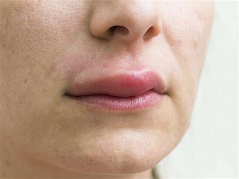 Angioedema: 10 Symptoms of Angioedema