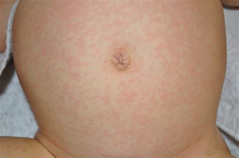 What Is A Viral Rash Baby at Joseph Leach blog
