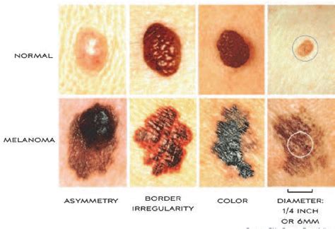 Nodular Malignant Melanoma