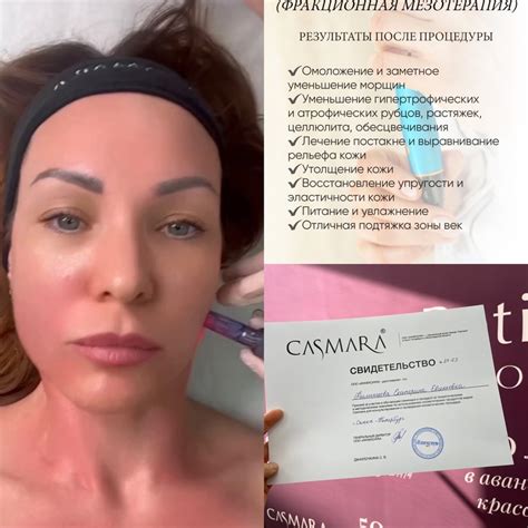 Микронидлинг (фракционная мезотерапия ) ! Процедура не опасна не вредна ...