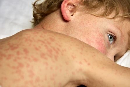All You Need to Know About Measles - Robert Gallery