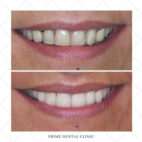 facetas dentarias prime dental clinic