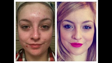 Final Month on Accutane! Before and After - YouTube