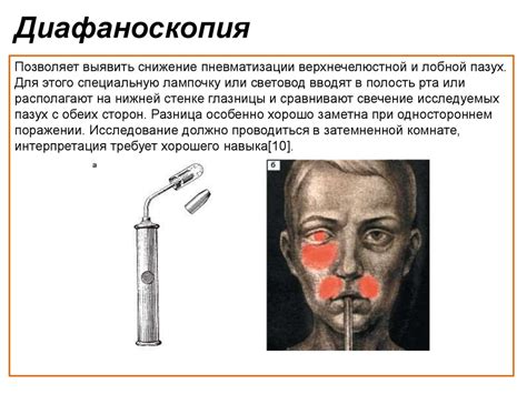 Острые синуситы - презентация онлайн