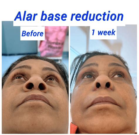 Alar Base Reduction (Nostril Reduction) - Harley Clinic