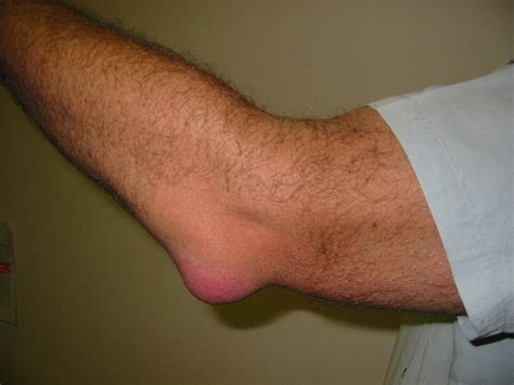 olecranon bursitis orthopaedic wellness links