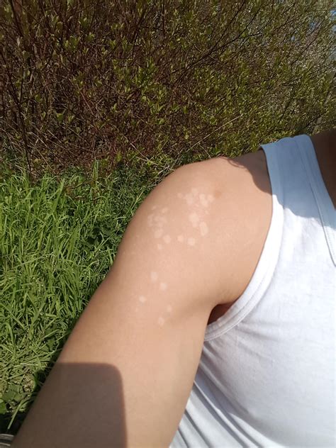 tinea versicolor vs vitiligo - Captions Week