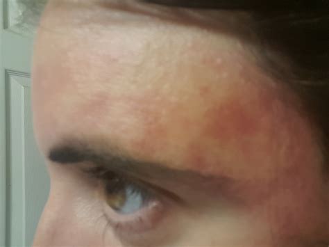 blood vessels in face burst 7