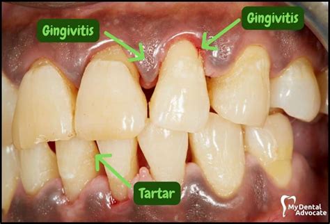 Gingivitis Vine at Andrew Gillan blog