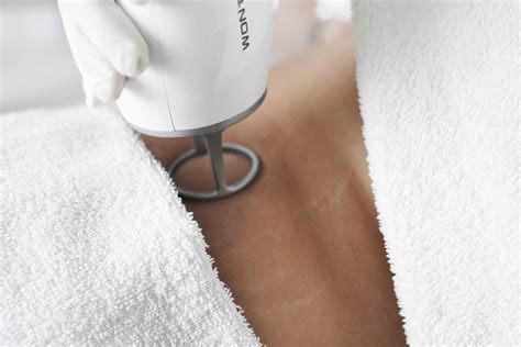 Striae | Derma Center
