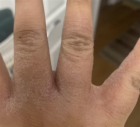 Eczema? Or scabies (crusted)? : r/scabies