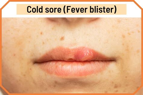 Blister on Lip: Cold Sores and 13 Other Causes (with Pictures)