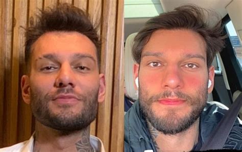 Lucas Lucco Antes E Depois - Lucas Lucco faz reversão da harmonização facial e mostra o resultado ...