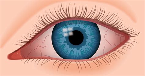 Laxmi Homeo Clinic: Dry Eyes treatment and remedies
