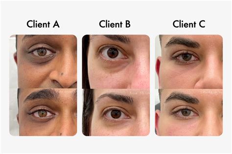 instant refresh  magic   eye filler explained