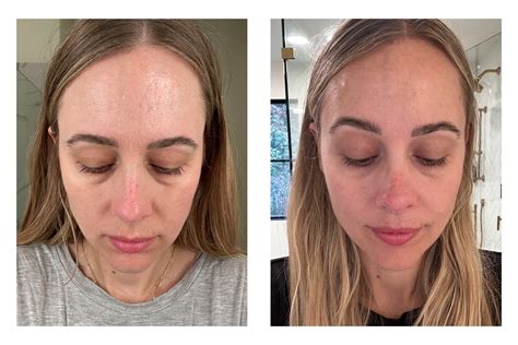 My ZO Skin Health Routine, Plus Before & After Pictures - Fashion Jackson