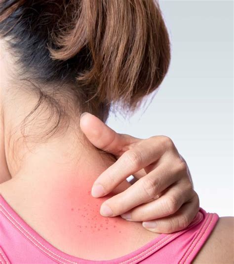 Hiv Symptoms Rash - Infoupdate.org