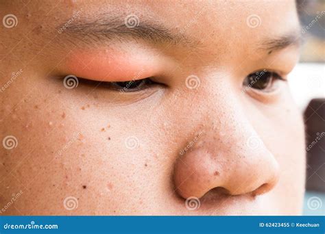 Swollen Upper Eyelid Stye