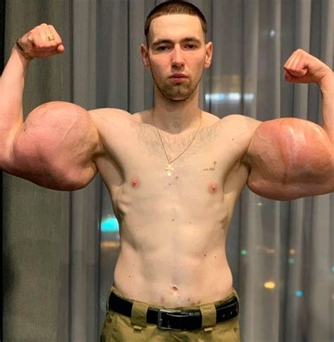 'Russian Popeye' Is Concerning Fans With Footage Of Him Flexing Jelly Injected Arms