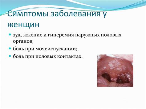 Трихомониаз - презентация онлайн