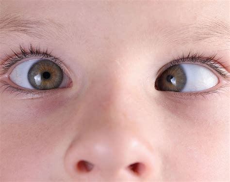 Suero autólogo | Tratamiento del ojo seco