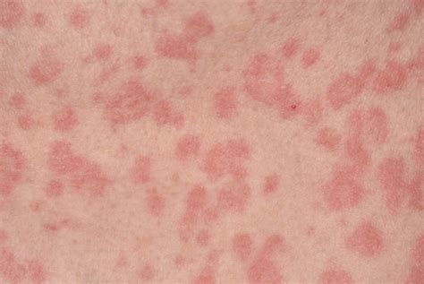 Red Bumps On Skin Not Itchy