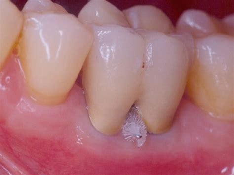 Should I Switch Dentists to Save a Furcation Involvement Tooth?