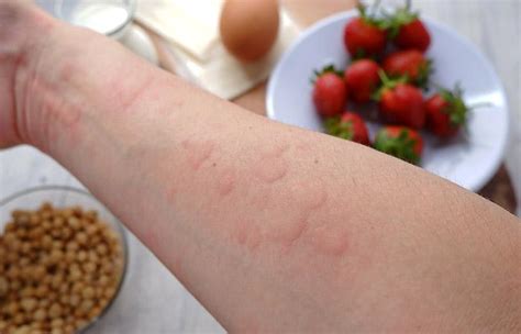 Ulcerative Colitis Rash: Causes, Symptoms, & How To Manage It