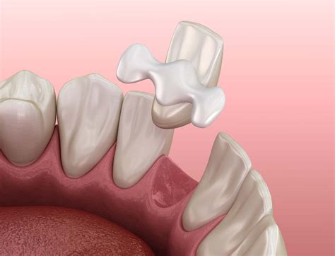 9 Things to Know About Dental Bridges