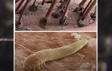 Sabia que sua cabeça pode estar cheia de ácaro Demodex?