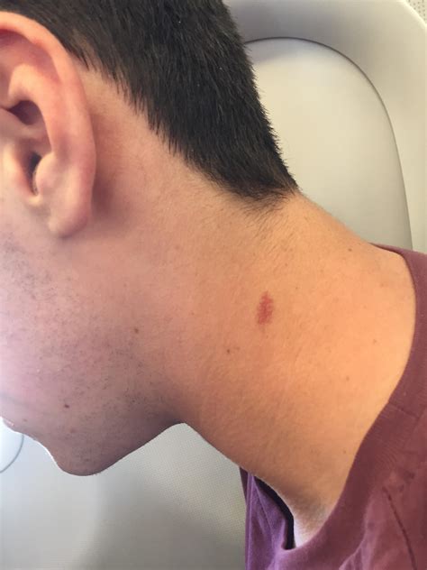 Marks On Neck That Looks Like Hickey at John Kathryn blog
