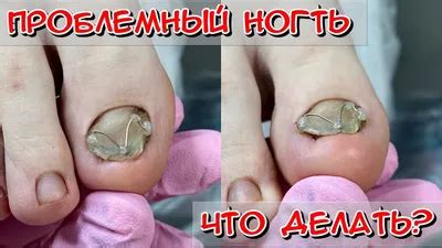 80+ Дистрофия ногтя на ноге фото