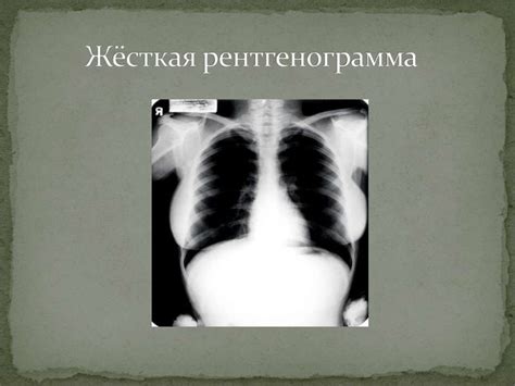 Анализ рентгенограммы грудной клетки - презентация онлайн