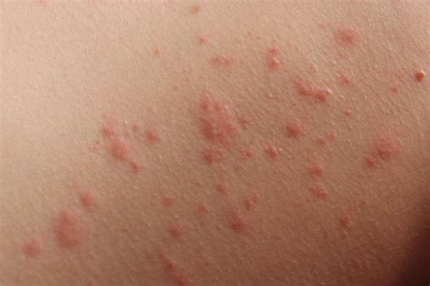 common rashes  babies  kids