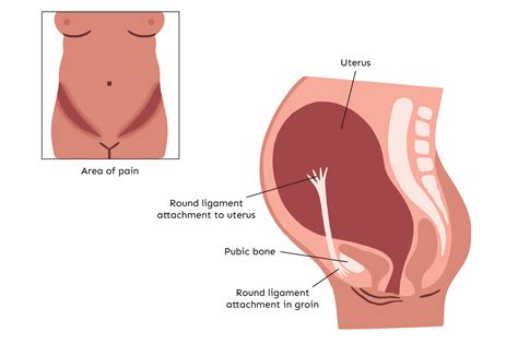 Round Ligament Pain in Pregnancy: How To Find Relief - Pregnancy Friend