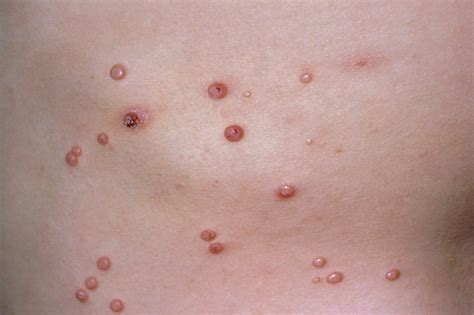 Užkrečiamasis Moliuskas: Simptomai, Priežastys ir Gydymo Būdai | iDerma