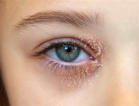 itchy crusty eyelids  introduction  demodex blepharitis