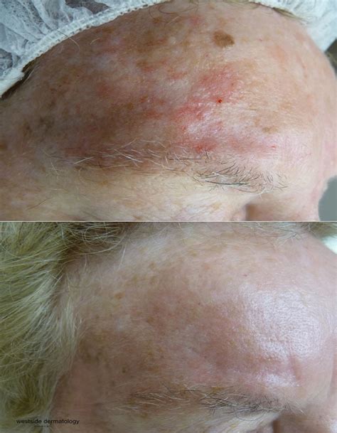 Skin Cancer - Cutis Dermatology