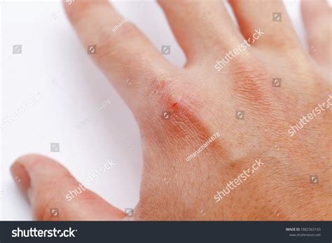 Mans Hand Chapped Skin Caused By Stock Photo 1882363165 | Shutterstock