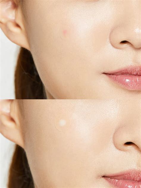 Пачове за пъпки Cosrx Acne Pimple Master Patch - BestCare