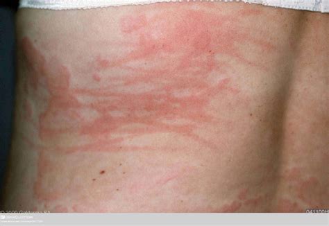 Urticaria Na Testa Figure, Urticaria Pigmentosa DermNet New Zealand]