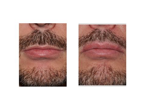 Why Do I Have Upper Lip Hair As A Man - Infoupdate.org