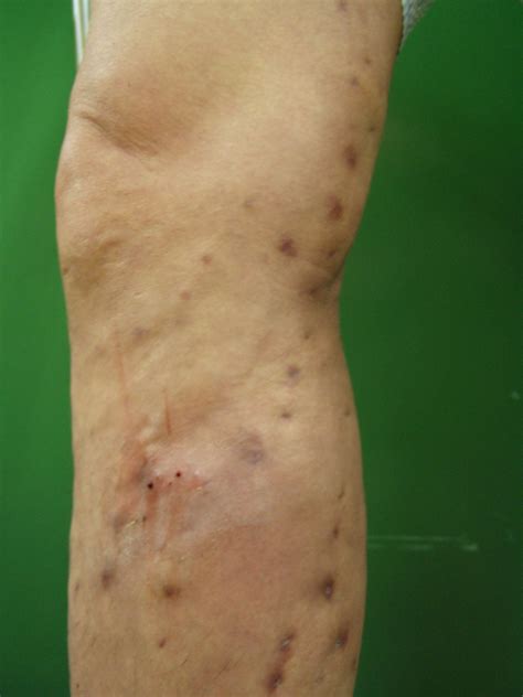 Varikose postoperativ - DocCheck