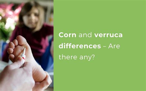 Corn and Verruca differences - Are there any? Expert Advice