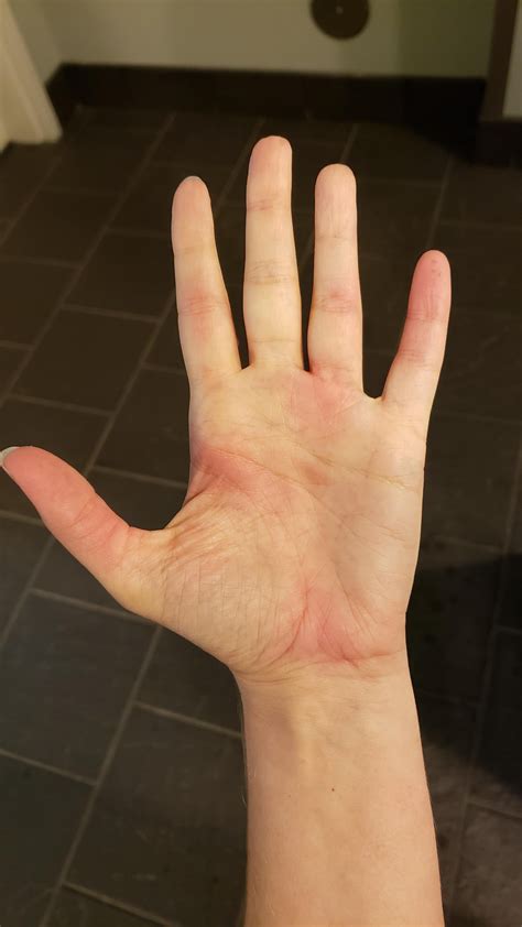Red, swollen, ITCHY hands! (Palms, fingers, joints) NO PAIN! Read