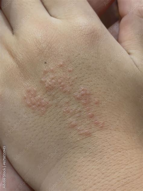 The rash is red and has small, clear blisters. On the skin on the back