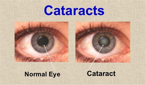 Cataract Eye Treatment - Ahalia Foundation Eye Hospital