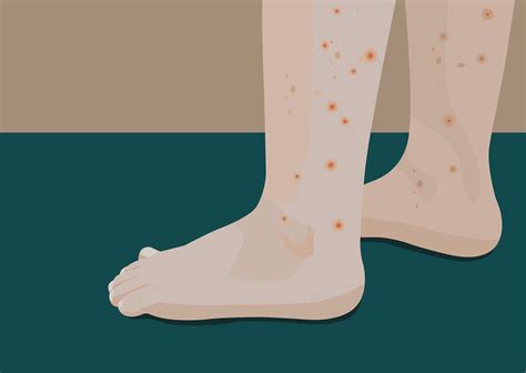 Cellulitis Infection Foot