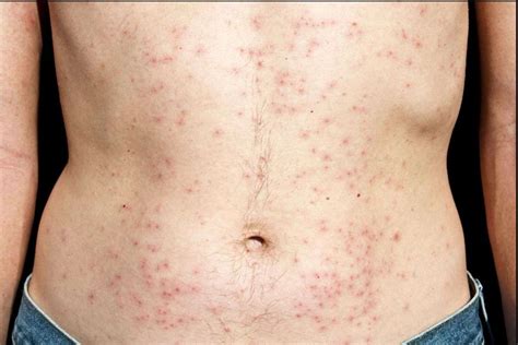 Skin Infections Caused by Bacteria-Causes and Treatments