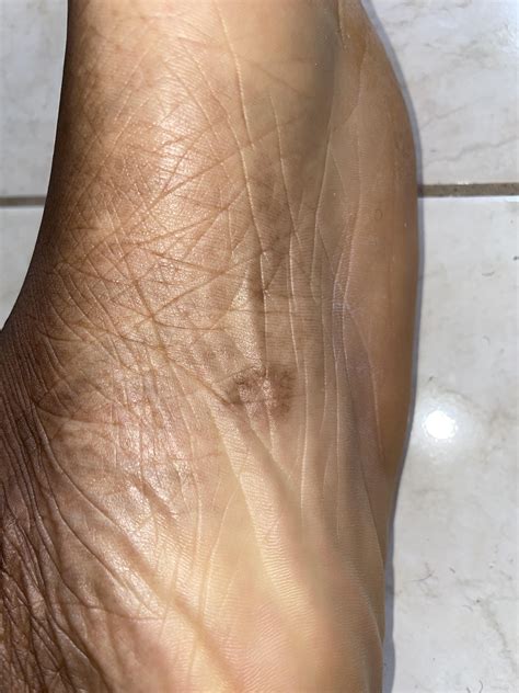 Could this be a foot melanoma? 23 Male African American. This spot